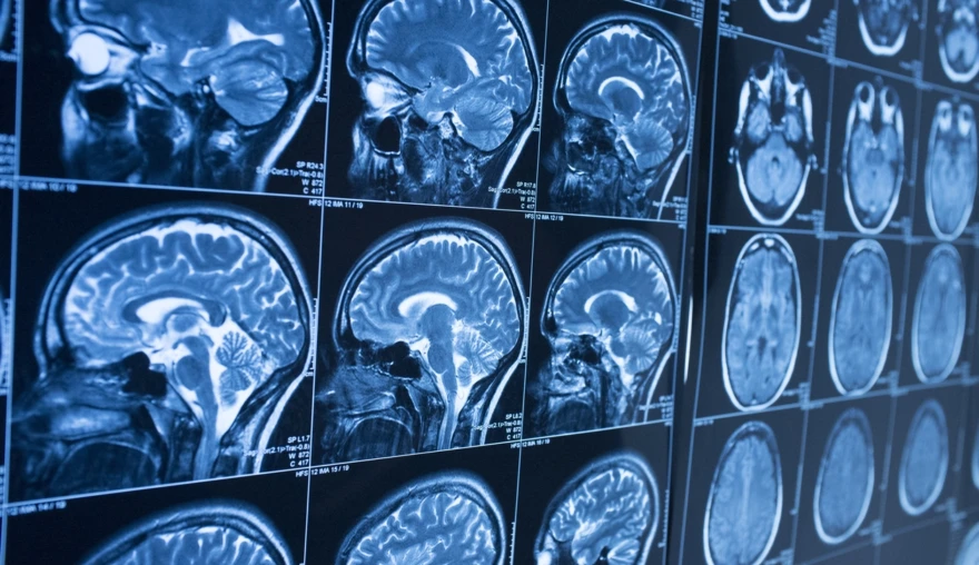 Videoblog: Mapping and investigating an unknown brain structure