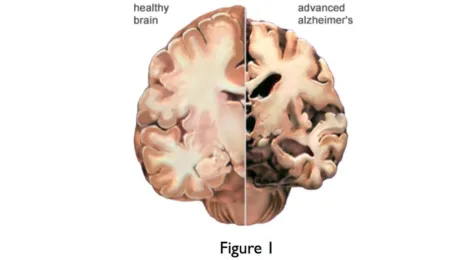 Early dementia and functional brain networks